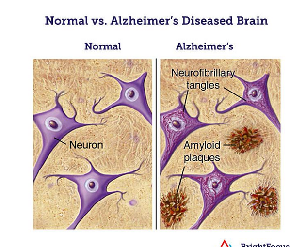 Amyloid plaques.PNG